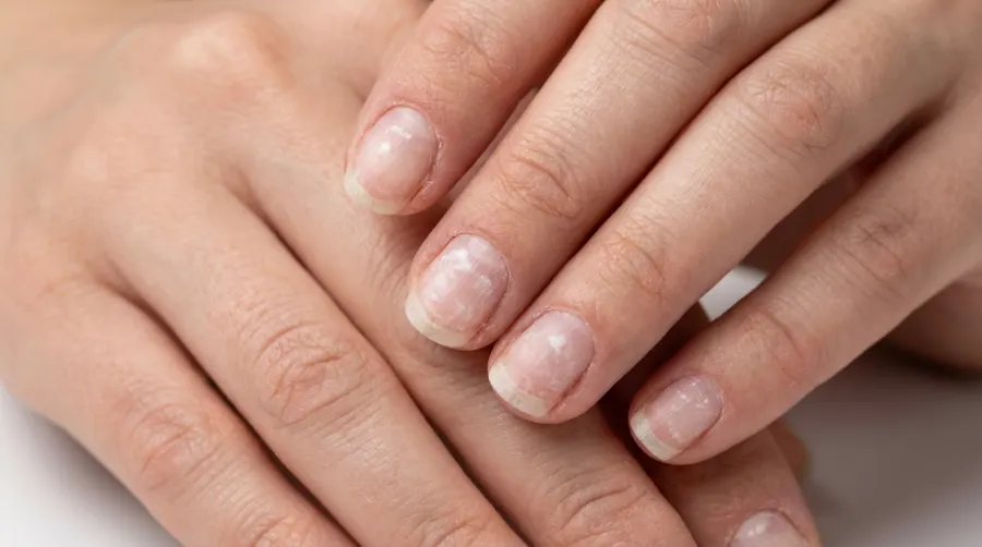 Zniszczone paznokcie z białymi plamami po manicure hybrydowym