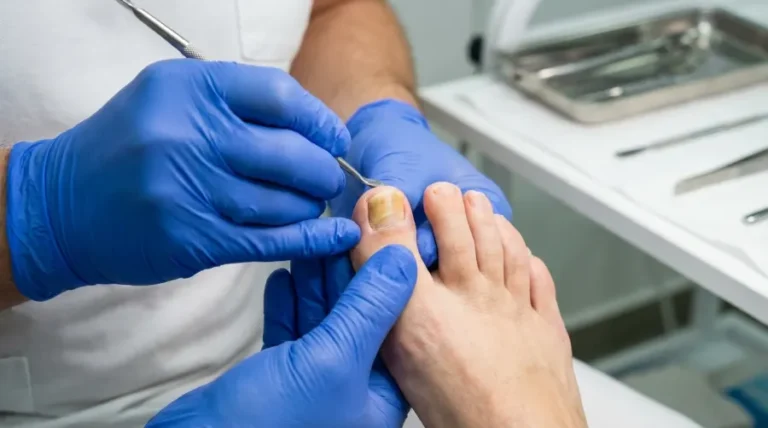 Diagnoza grzybicy paznokci po zdjęciu lakieru hybrydowego w gabinecie