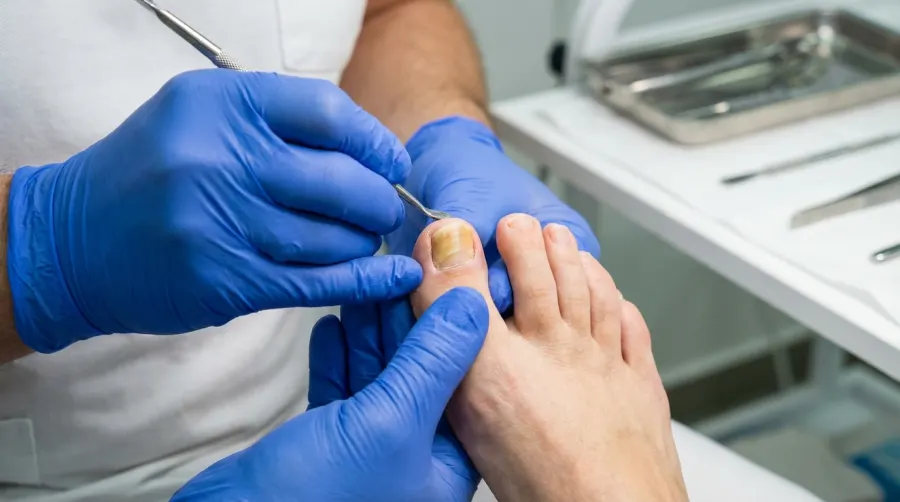 Diagnoza grzybicy paznokci po zdjęciu lakieru hybrydowego w gabinecie