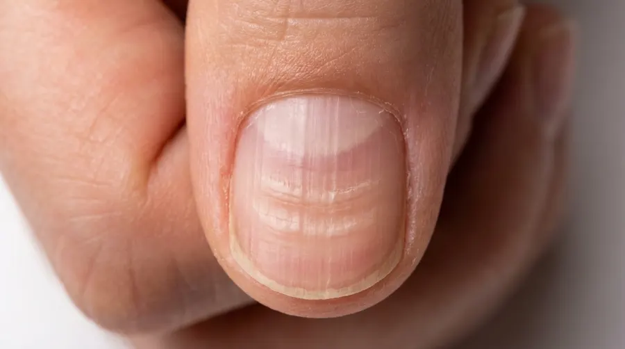 Poziome bruzdy i linie Beau na płytce paznokcia