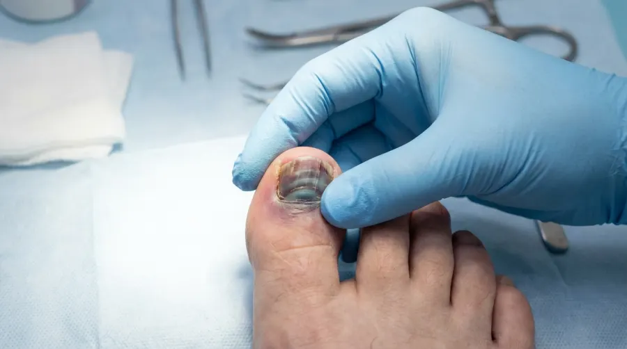 Podolog badający schodzący paznokieć na paluchu stopy